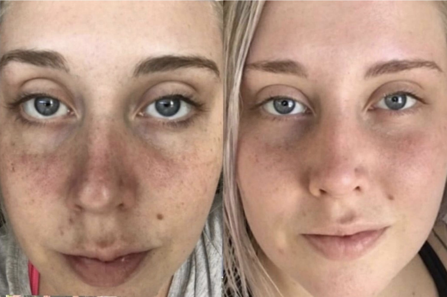 PRP benefits